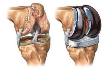 Лечение гонартроза коленного сустава в израиле